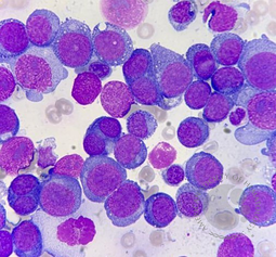 Acute Erythroid Leukemia (AML M6)