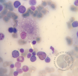 Gaucher cell