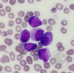 APL variant (FAB:AML-M3v) 2