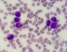 APL variant (FAB:AML-M3v) 3