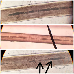 Griscelli syndrome
