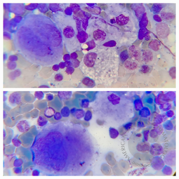 Gaucher's disease