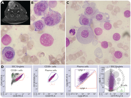 An unusual case of a multiple myeloma with thyroid involvement at primary diagnosis