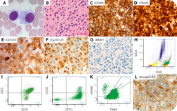 BRAF-negative, CD103-negative hairy cell leukemia