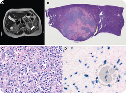 EBV-positive inflammatory FDC/FRC tumor: no longer pseudo or sarcoma!