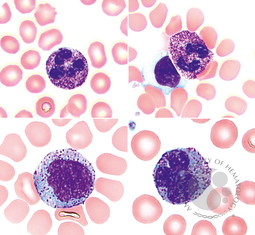 Neutrophils and monocytes with increased azurophilic granules resembling toxic changes in mucopolysaccharidosis type VI
