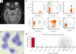 Hepatosplenic T-cell lymphoma with STAT5B and SETD2 mutations recurring as cells with NK-cell immunophenotype