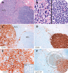 Composite ALK-negative anaplastic large-cell lymphoma and mantle cell lymphoma