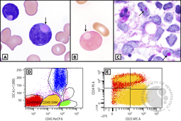 B-acute lymphoblastic leukemia with eosinophilic inclusions