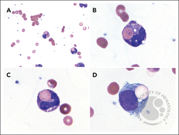 Peripheral erythrophagocytosis in paroxysmal cold hemoglobinuria