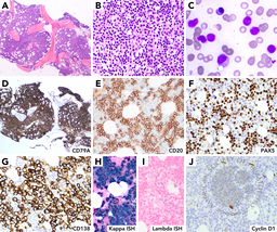 Lymphoplasmacytic lymphoma with IgG paraprotein and extensive plasmacytic differentiation mimicking plasma cell neoplasm
