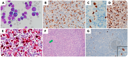 Effusion presentation of HHV-8–associated multicentric Castleman disease mimicking primary effusion lymphoma