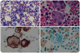Metastatic carcinoma mimicking hemophagocytic lymphohistiocytosis