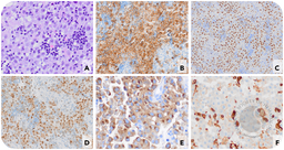 ALK-positive large B-cell lymphoma, a rare B-cell lymphoma expressing ALK