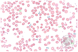 Four genetic red cell disorders in one