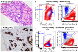 False CD10 positivity in MALT lymphoma involving kidney