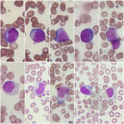 Infectious mononucleosis