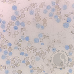 Blasts stained with brilliant cresyl blue