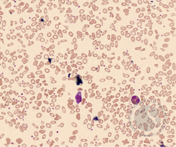 Hereditary Pyropoikilocytosis