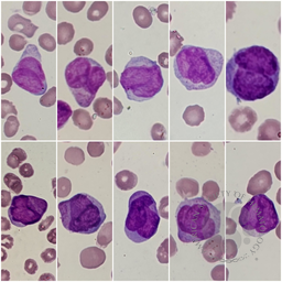 Blasts in APL hypogranular