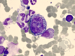 Hodgkin Cell