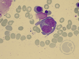 Reed-Sternberg Cell