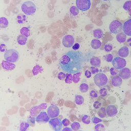Pseudo-Gaucher cell in Chronic Myeloid Leukemia