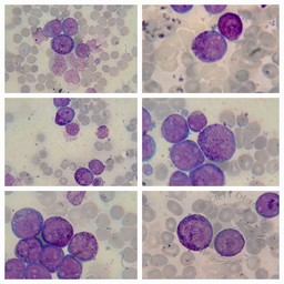 Hypergranulated Acute Promyelocytic Leukemia