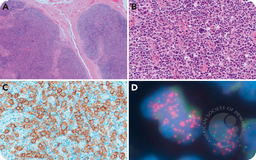 ALK-negative anaplastic large cell lymphoma with JAK2 rearrangement mimicking classic Hodgkin lymphoma
