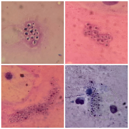 Pneumocystis 2