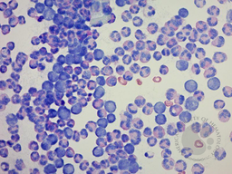 AML involving left knee joint 1