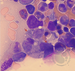 Disseminate Histoplasmosis