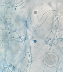 Disseminate Histoplasmosis 3