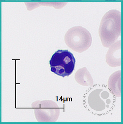 Apoptotic lymphocyte 1