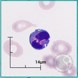 Apoptotic lymphocyte 2