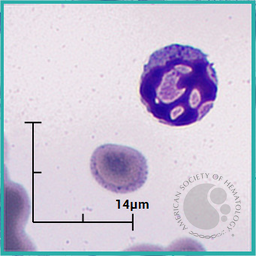 Apoptotic lymphocyte 3
