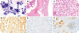 A rare case of well-differentiated systemic mastocytosis