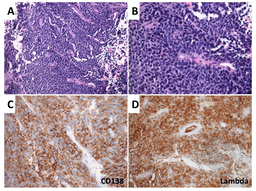 Plasma cell neoplasm with papillary architecture mimicking carcinoma