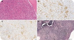 A challenging diagnosis of myeloid/lymphoid neoplasm with eosinophilia and FIP1L1::PDGFRA rearrangement