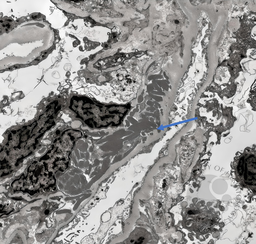 Subendothelial Crystals