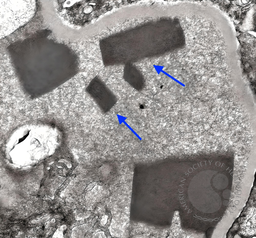 Intraluminal Crystals