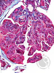 Hyaline Microthrombi