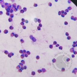 Eosinophils in nasal smear