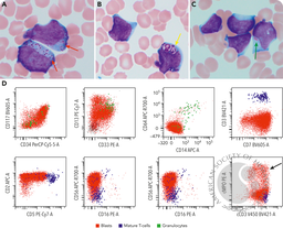 Pediatric mixed phenotype acute leukemia, T/myeloid, with isolated FLT3 mutation