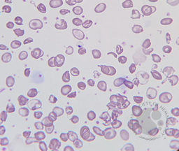 Poikilocytosis