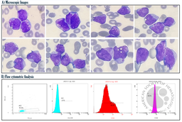 HLA-DR Negative AML