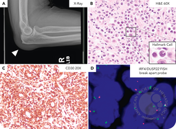 IRF4/DUSP22-positive anaplastic large cell lymphoma arising in the setting of chronic olecranon bursitis