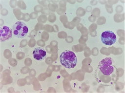 Peripheral smear Eosinophilia