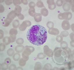 Peripheral blood Eosinophilia 3