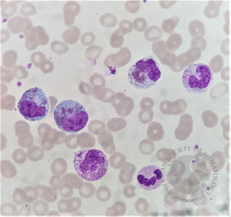 Peripheral blood Eosinophilia 4